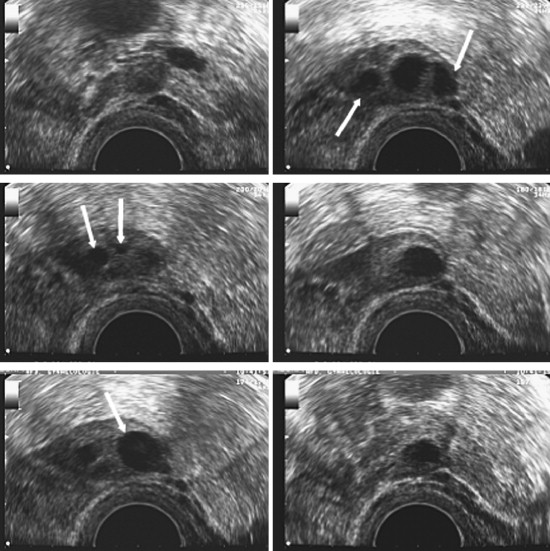 AFC Antral Follicle Count Test in Noida Process