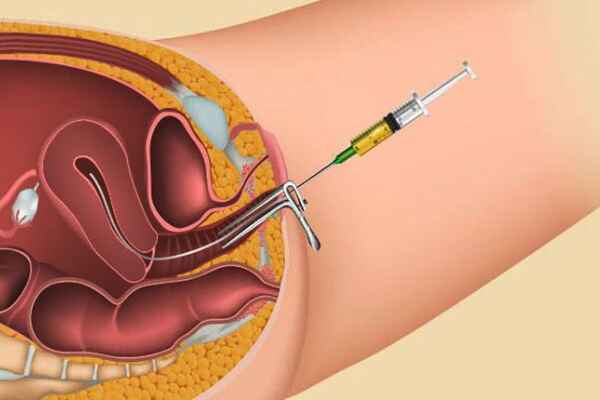 PCOD PCOS Treatment in Noida - Anaya IVF & Fertility Care